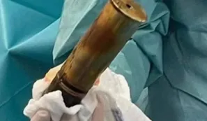 Llegó con una bomba de la Primera Guerra Mundial en el recto y tuvieron que evacuar el hospital