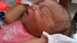 Estados Unidos: médicos le cortaron la cara a una beba durante el parto por cesárea