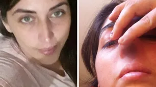 Caleta Olivia: perdió el cartilago de la nariz por un hisopado "mal hecho" y exige una reconstrucción
