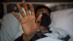Viruela del mono en la Argentina: ya hay 22 casos en total, la mayoría varones entre 20 y 49 años