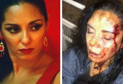 Bailarina argentina sufrió una brutal golpiza de su expareja