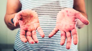 La OMS alerta por el aumento de casos de sarampión en todo el mundo