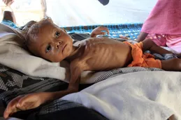 Tiene 3 años y pesa 4 kilos: el estremecedor caso de la niña yemení Randa Ali