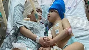 Separaron a dos gemelos siameses unidos por la cabeza en una cirugía histórica