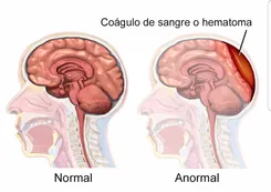 Qué es un hematoma subdural, el diagnóstico de Ginés González García