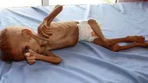 Naciones Unidas admite que "pierde la batalla" contra el hambre en Yemen