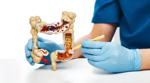 Identificaron células claves para evitar la metástasis y las recaídas del cáncer de colón