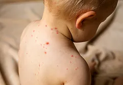 Las cuatro razones por las que el sarampión resurgió como epidemia mundial