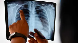 La tuberculosis crece a la par de la pobreza