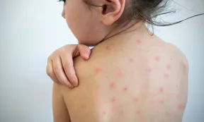 Hay alerta por cuatro brotes de sarampión y un llamado urgente para que la población se vacune