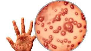 Viruela del mono: con más de 6000 casos en el mundo, la OMS evalúa decretar "emergencia sanitaria mundial"
