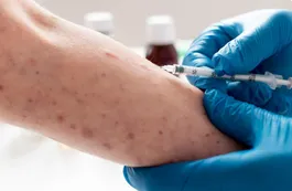 Un informe de instituciones de salud de Michigan advirtió sobre la evolución clínica del sífilis y la mutación de síntomas tradicionales