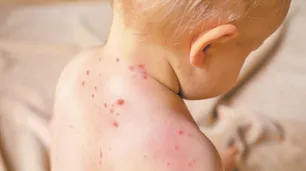 Alerta por brote de sarampión en Florida: 15 estados afectados y la preocupación por falta de vacunación