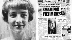 El trágico final de Janet Parker, la última víctima mortal de la viruela en el mundo