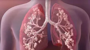 Reclaman la sanción de la Ley de Fibrosis Quística