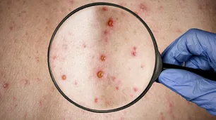 Viruela del mono: claves para entender al virus que ya está en Argentina