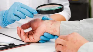Una vacuna contra el melanoma reduce el riesgo de muerte en un 44%, según el ensayo clínico