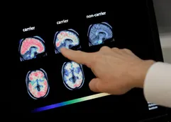 Aprobaron en Estados Unidos un fármaco que permitiría neutralizar el avance del Alzheimer