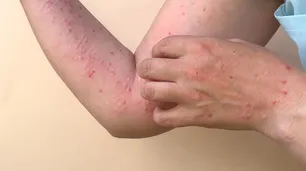 La viruela del mono: el virus llegó a Santa Fe y ya son 24 los casos en el país