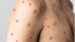 Brote de viruela del mono en África: 15 países afectados y podría declararse un estado de emergencia de salud pública