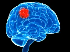 Qué es el glioblastoma, el tumor que padecía Claudio Bonadio
