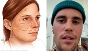 Qué es el síndrome de Ramsay Hunt que le paralizó media cara a Justin Bieber