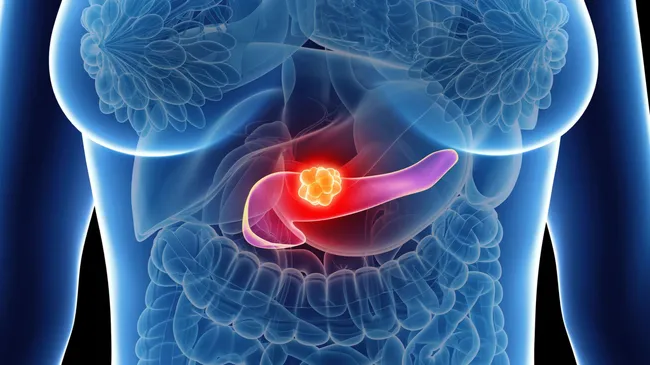 Cáncer de páncreas: una píldora duplica la supervivencia de pacientes graves