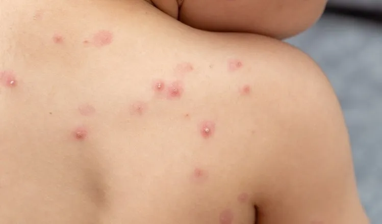 Confirman el primer caso de una persona infectada por una variante más contagiosa y severa de viruela del mono